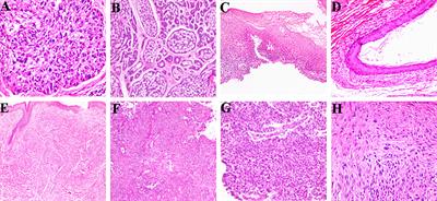 The clinicopathological analysis of ocular and orbit tumors in southeast of China